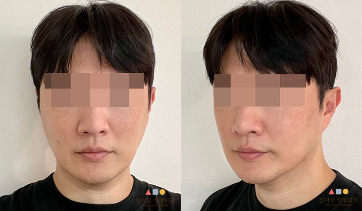 수술 후