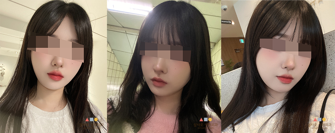 수술 후