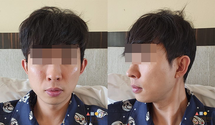 수술 후