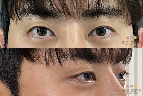 수술 후