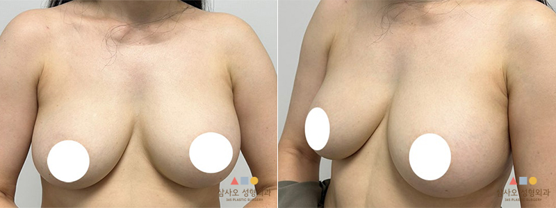 수술 전