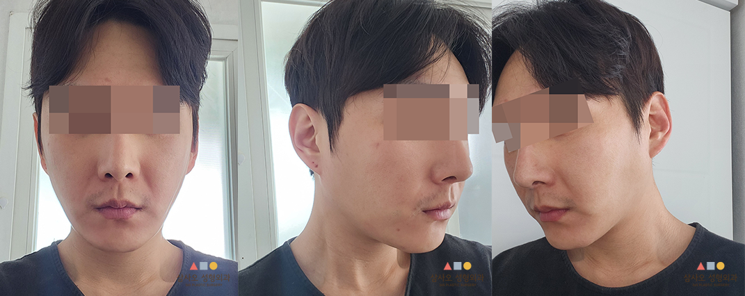 수술 후