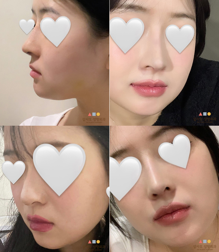 수술 후