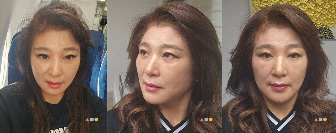 수술 후