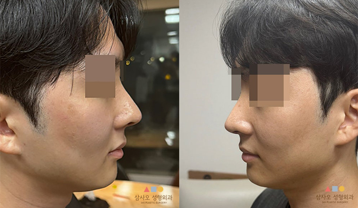 수술 후