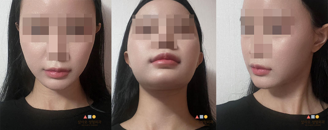 수술 전