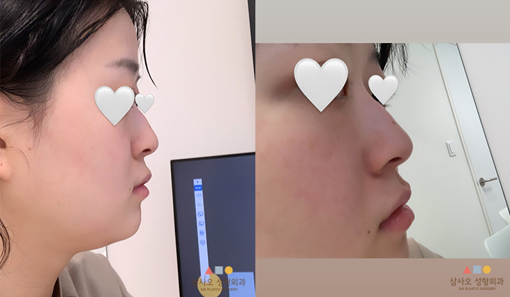 수술 전