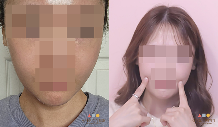 수술 후