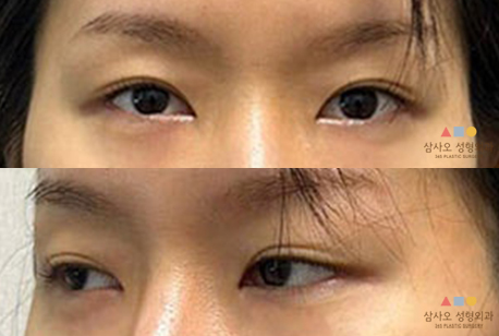 수술 전