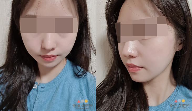 수술 후