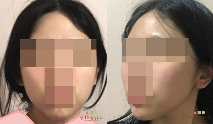 수술 후