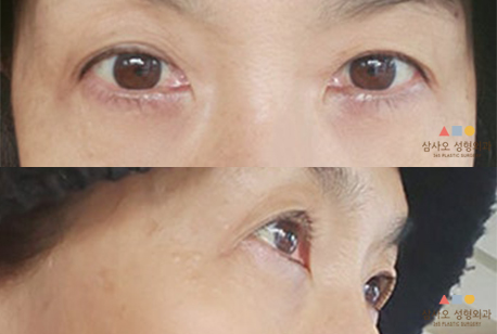 수술 후