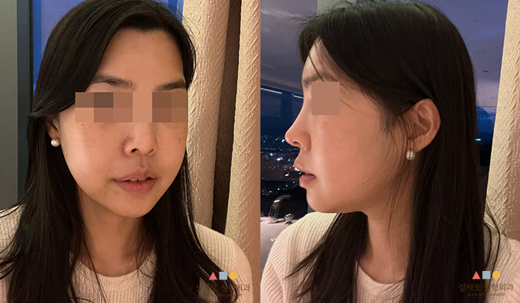 수술 후