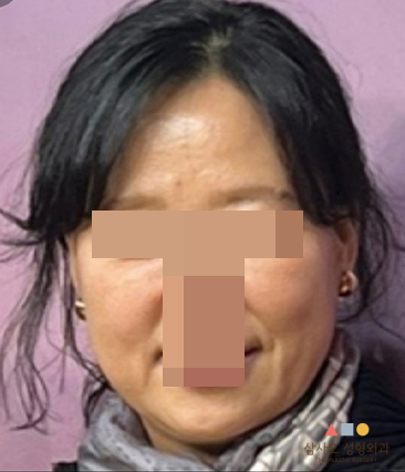 수술 전