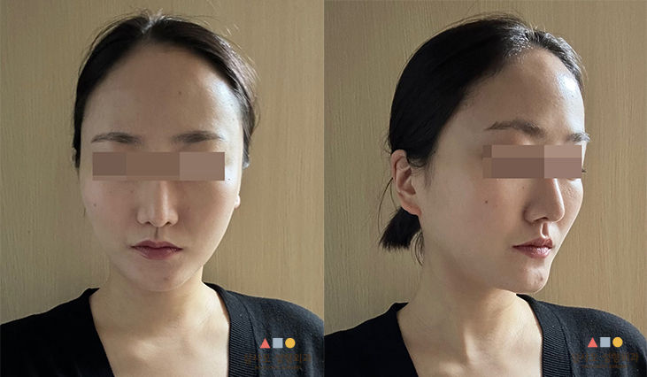 수술 전