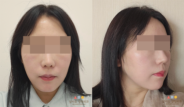 수술 후
