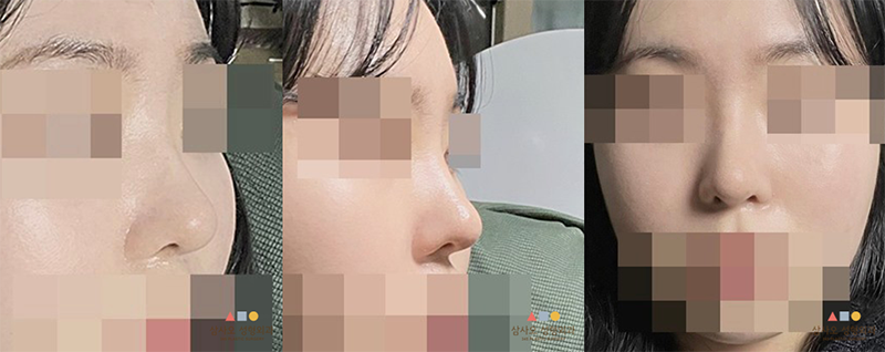 수술 후