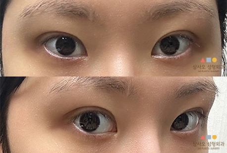 수술 후