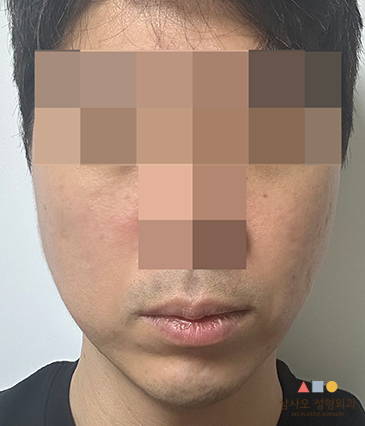 수술 후