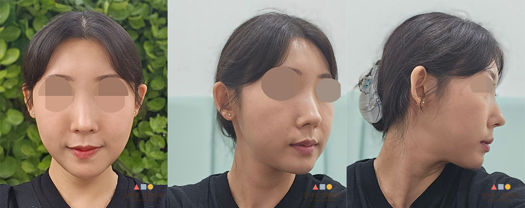 수술 후