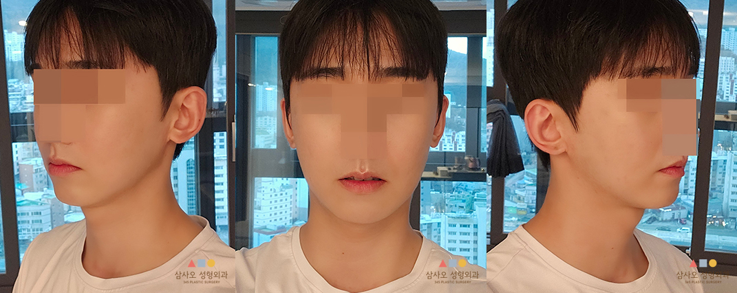 수술 후