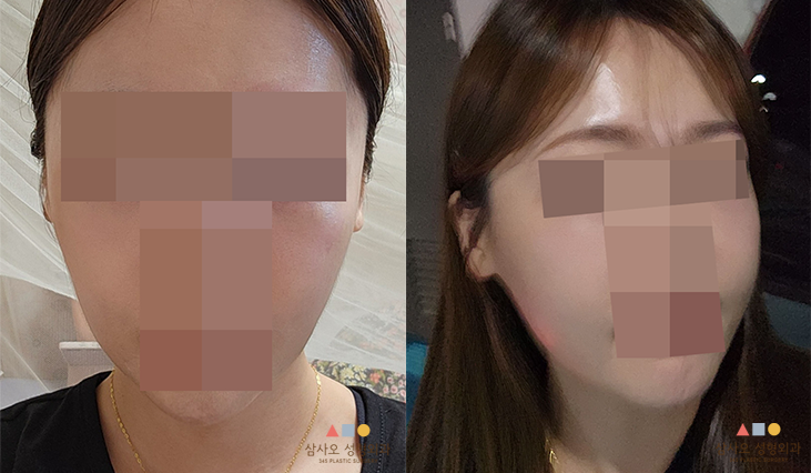 수술 후