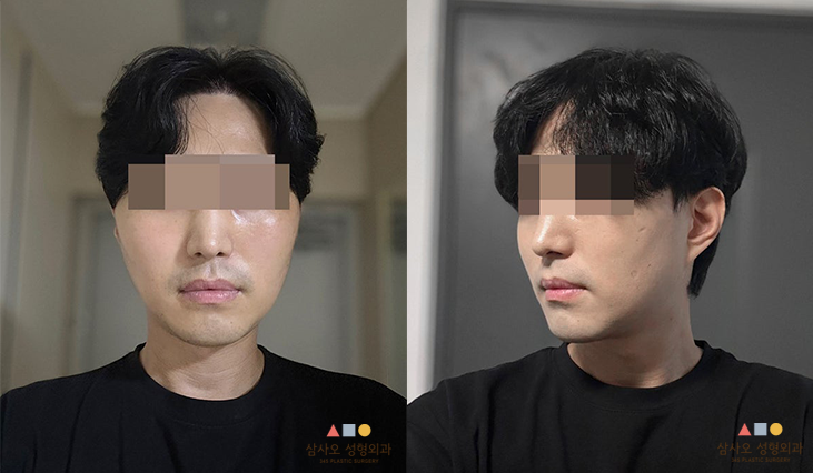수술 후