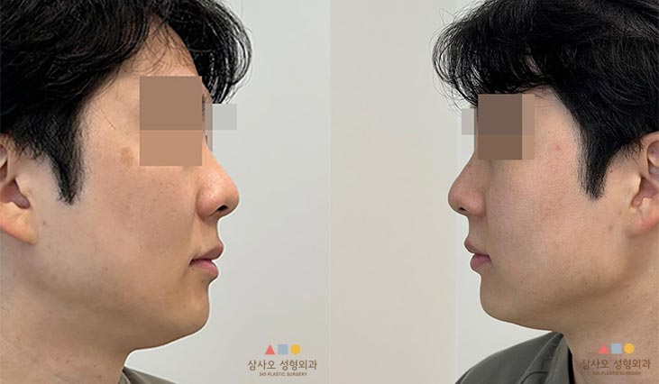 수술 전