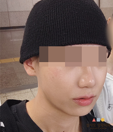 수술 후