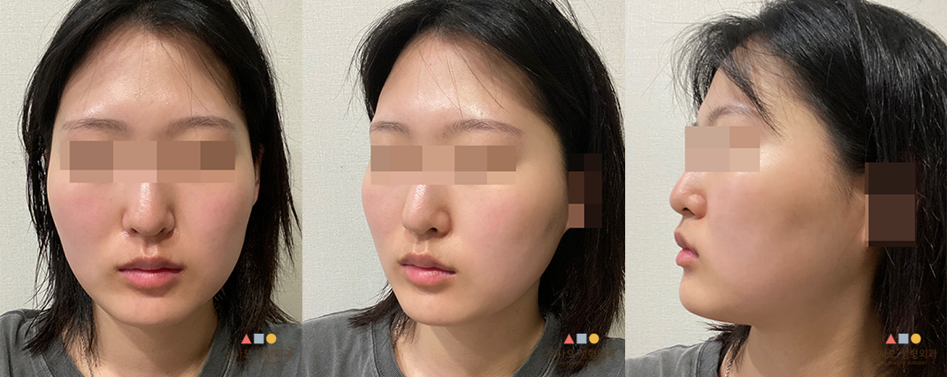 수술 전