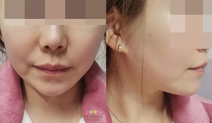 수술 후