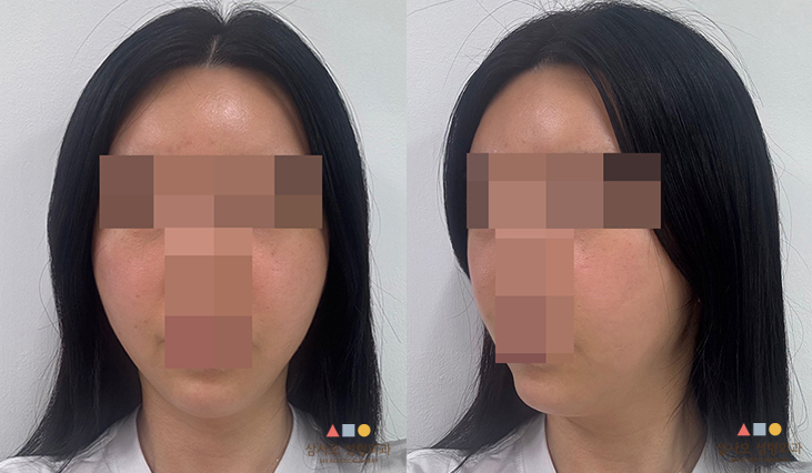 수술 후