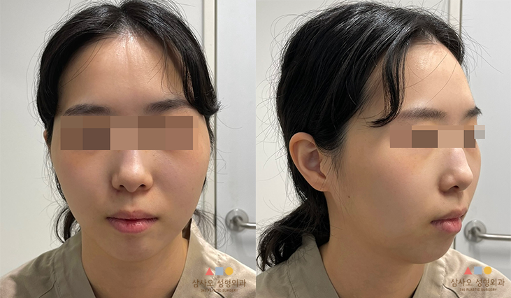 수술 전