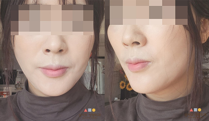 수술 후