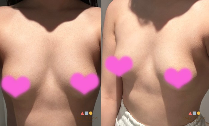 수술 전