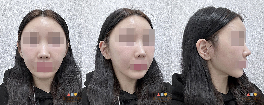 수술 후