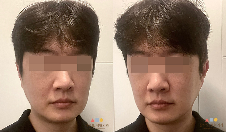 수술 전