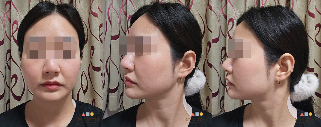 수술 전