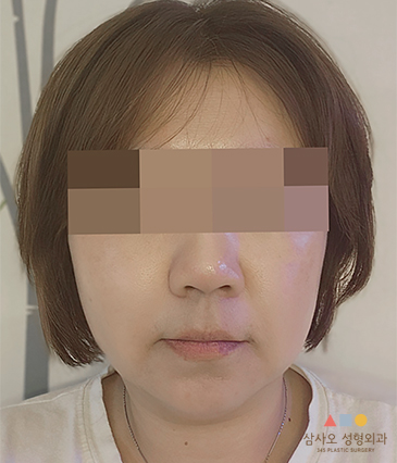 수술 후