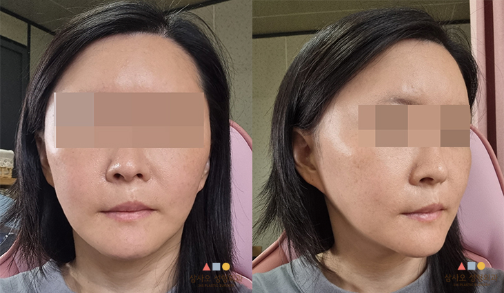 수술 후