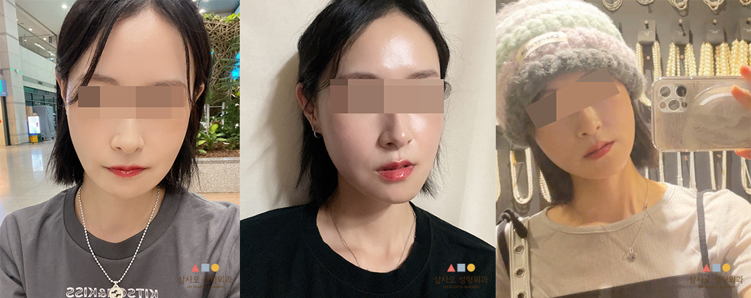 수술 후
