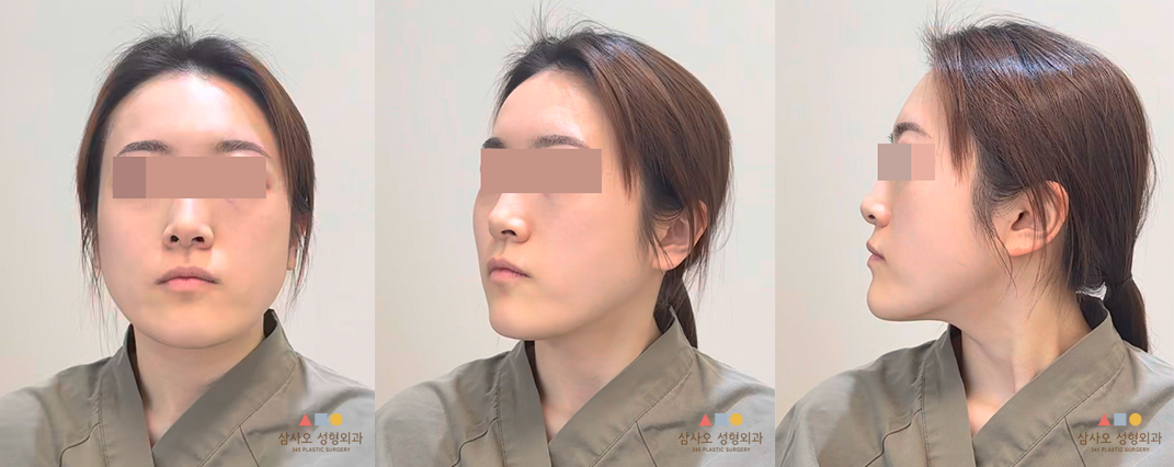 수술 전