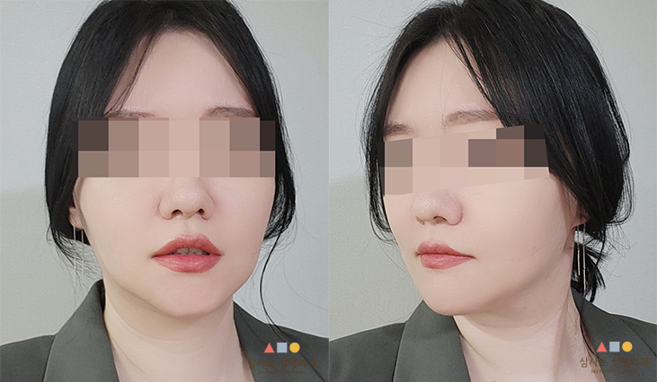 수술 후