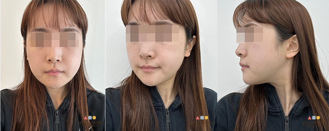 수술 후