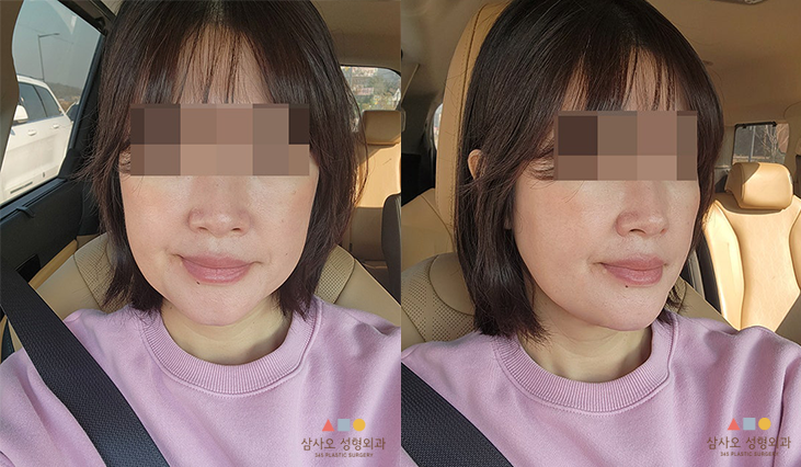 수술 후