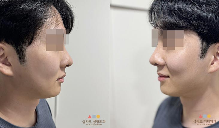 수술 후