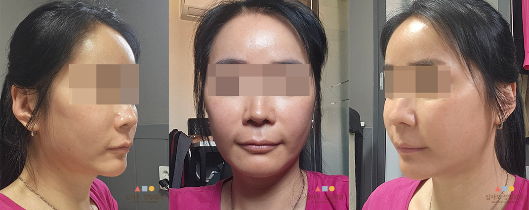 수술 후