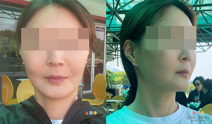 수술 후