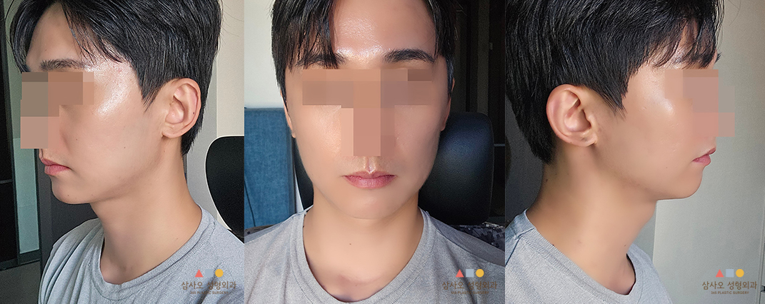 수술 전