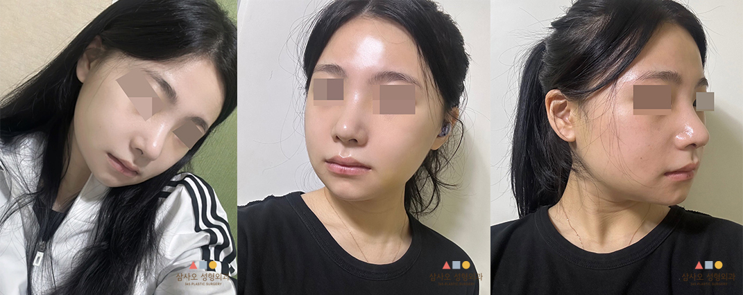 수술 후